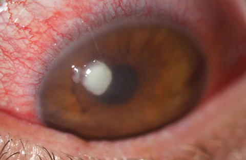 Microbial Keratitis Risk Factors: Who Ends Up With a Corneal Ulcer, and Why