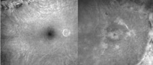 Clinical eye photograph illustrating Microcystic Macular Edema Optic Neuropathy