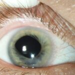 Clinical eye photograph illustrating Microphthalmia Coloboma Syndrome Workup