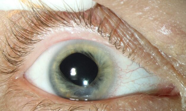 Microphthalmia and Coloboma Syndromes: Working Up the Small, Incomplete Eye