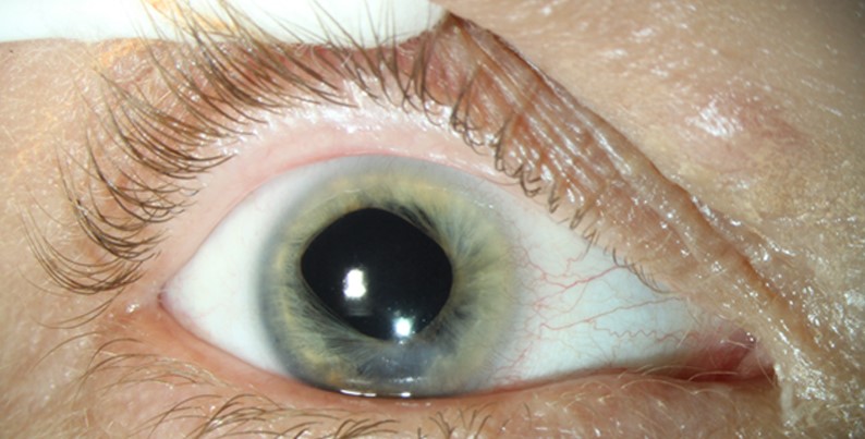 Microphthalmia and Coloboma Syndromes: Working Up the Small, Incomplete Eye