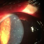 Clinical eye photograph illustrating Microsporidial Keratoconjunctivitis