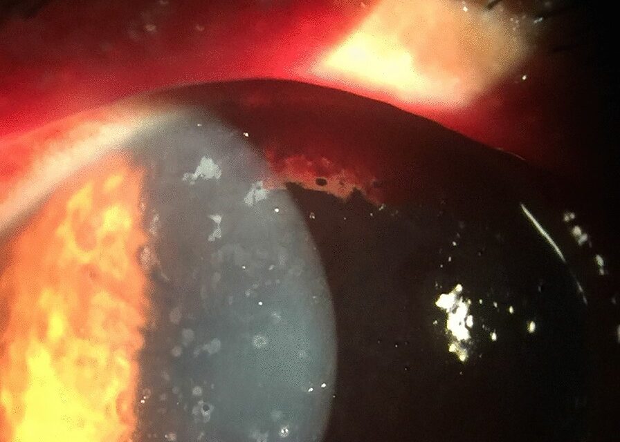 Microsporidial Keratoconjunctivitis: A Small Organism That Mimics Adenovirus