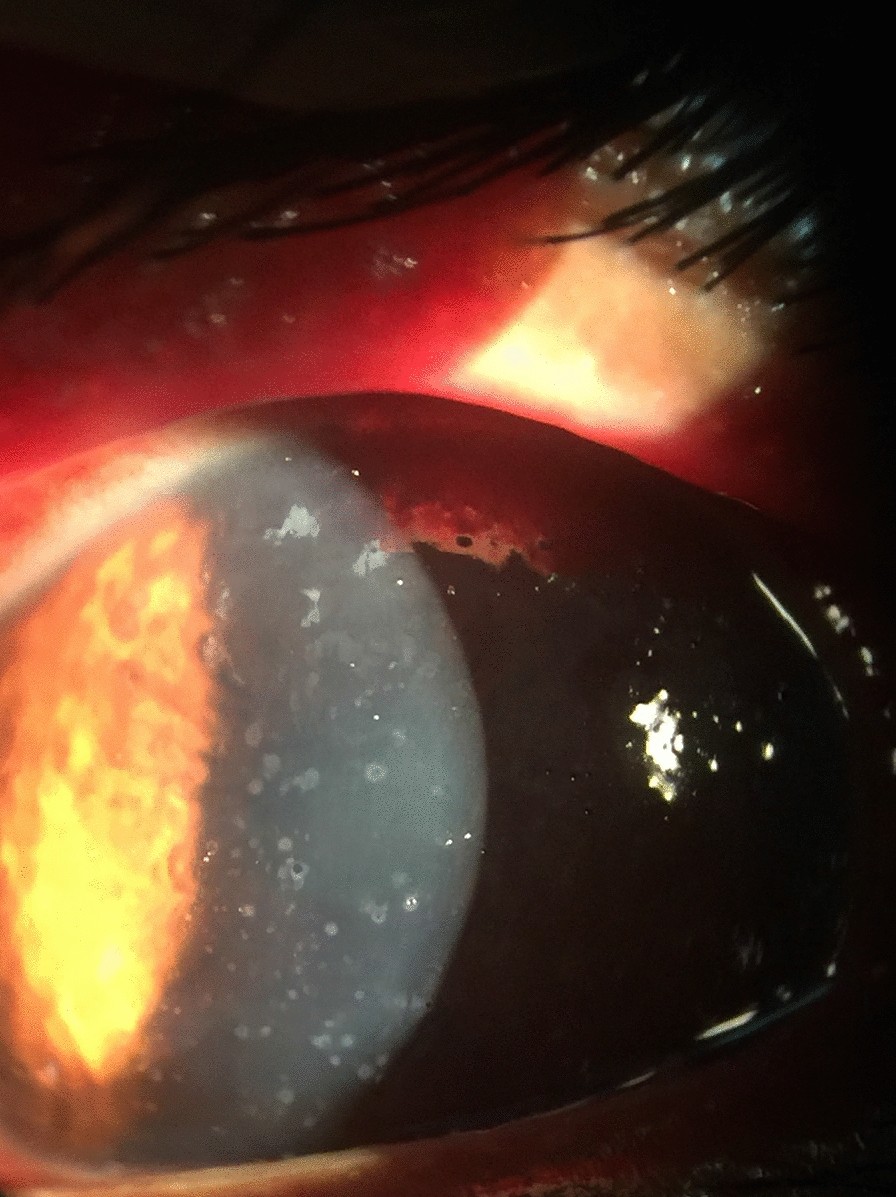 Clinical eye photograph illustrating Microsporidial Keratoconjunctivitis