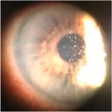Clinical eye photograph illustrating Microsporidial Keratoconjunctivitis