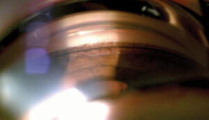 Clinical eye photograph illustrating Minimally Invasive Glaucoma Surgery