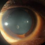 Clinical eye photograph illustrating Mittendorf Dot