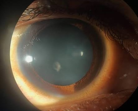 Mittendorf Dot: The Small White Spot on the Back of the Lens Left by the Fetal Hyaloid Artery
