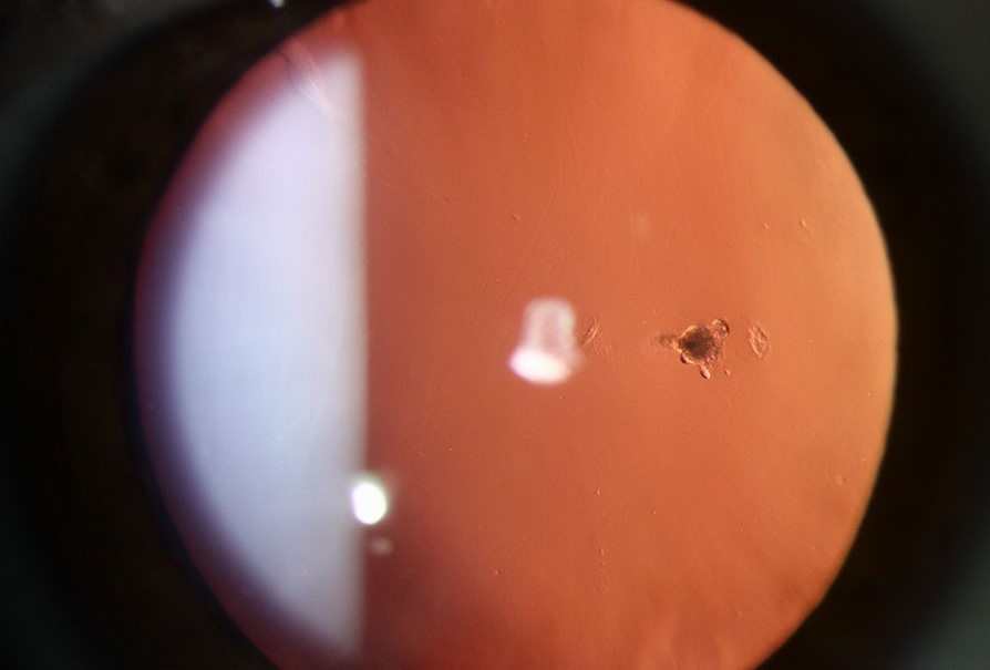 Clinical eye photograph illustrating Mittendorf Dot