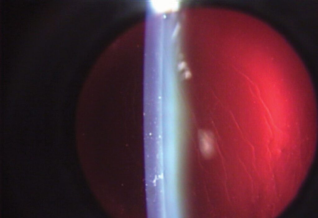 Clinical eye photograph illustrating Monovision Cataract Surgery