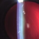 Clinical eye photograph illustrating Monovision Cataract Surgery