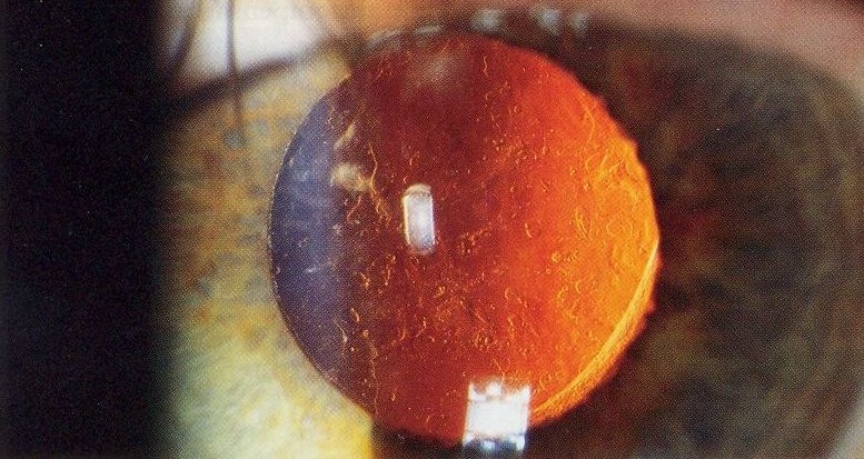 Clinical eye photograph illustrating Monovision Cataract Surgery