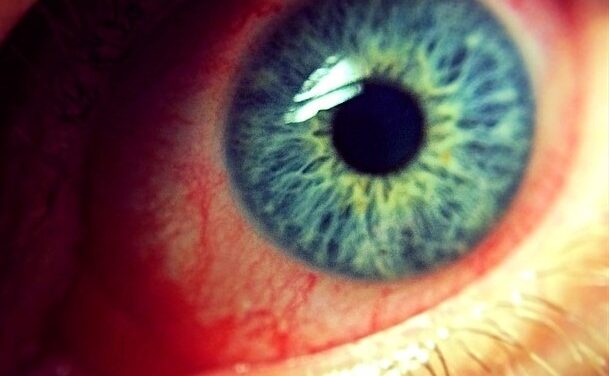 Mpox and the Eye: Eyelid Lesions, Conjunctivitis, and the Risk to the Cornea