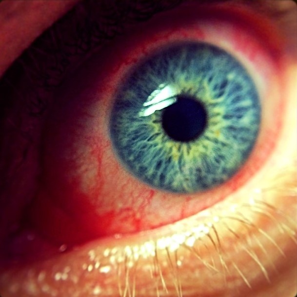 Clinical eye photograph illustrating Mpox Ocular Manifestations
