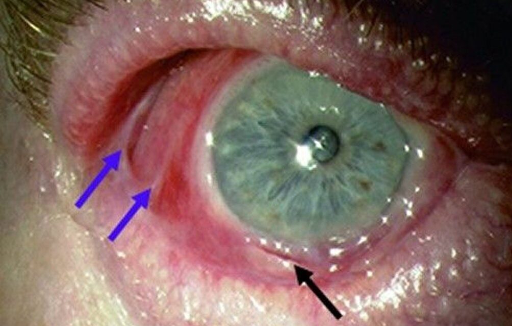 Ocular Mucous Membrane Pemphigoid: A Slow, Scarring Fire That Needs Early Systemic Treatment