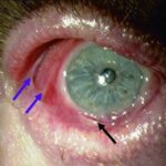 Clinical eye photograph illustrating Mucous Membrane Pemphigoid Eye
