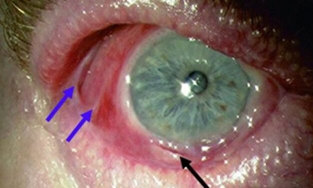 Ocular Mucous Membrane Pemphigoid: A Slow, Scarring Fire That Needs Early Systemic Treatment
