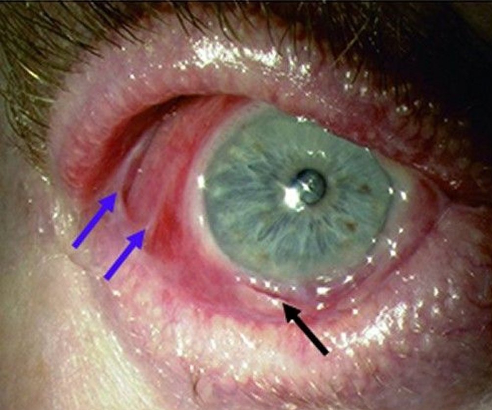 Clinical eye photograph illustrating Mucous Membrane Pemphigoid Eye