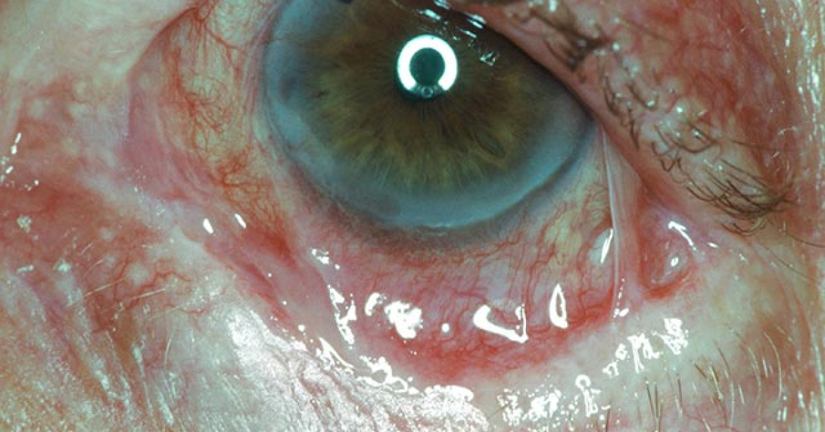 Clinical eye photograph illustrating Mucous Membrane Pemphigoid Eye