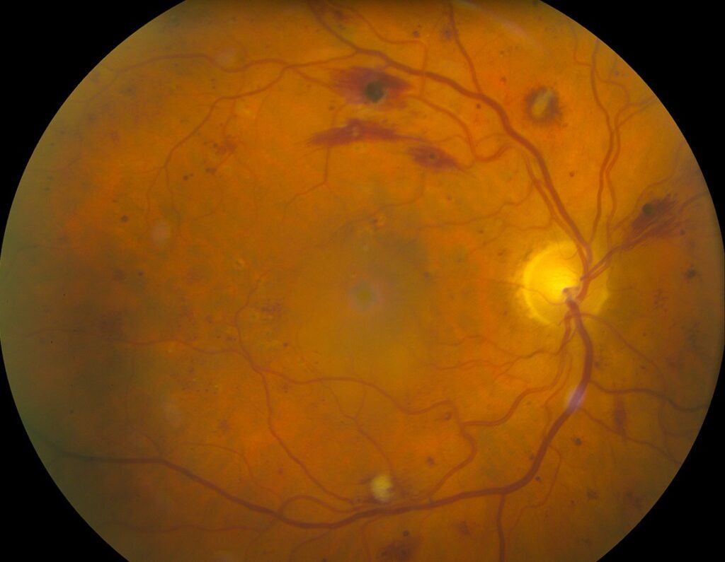 Clinical eye photograph illustrating Multiple Myeloma Retinopathy Hyperviscosity Eye
