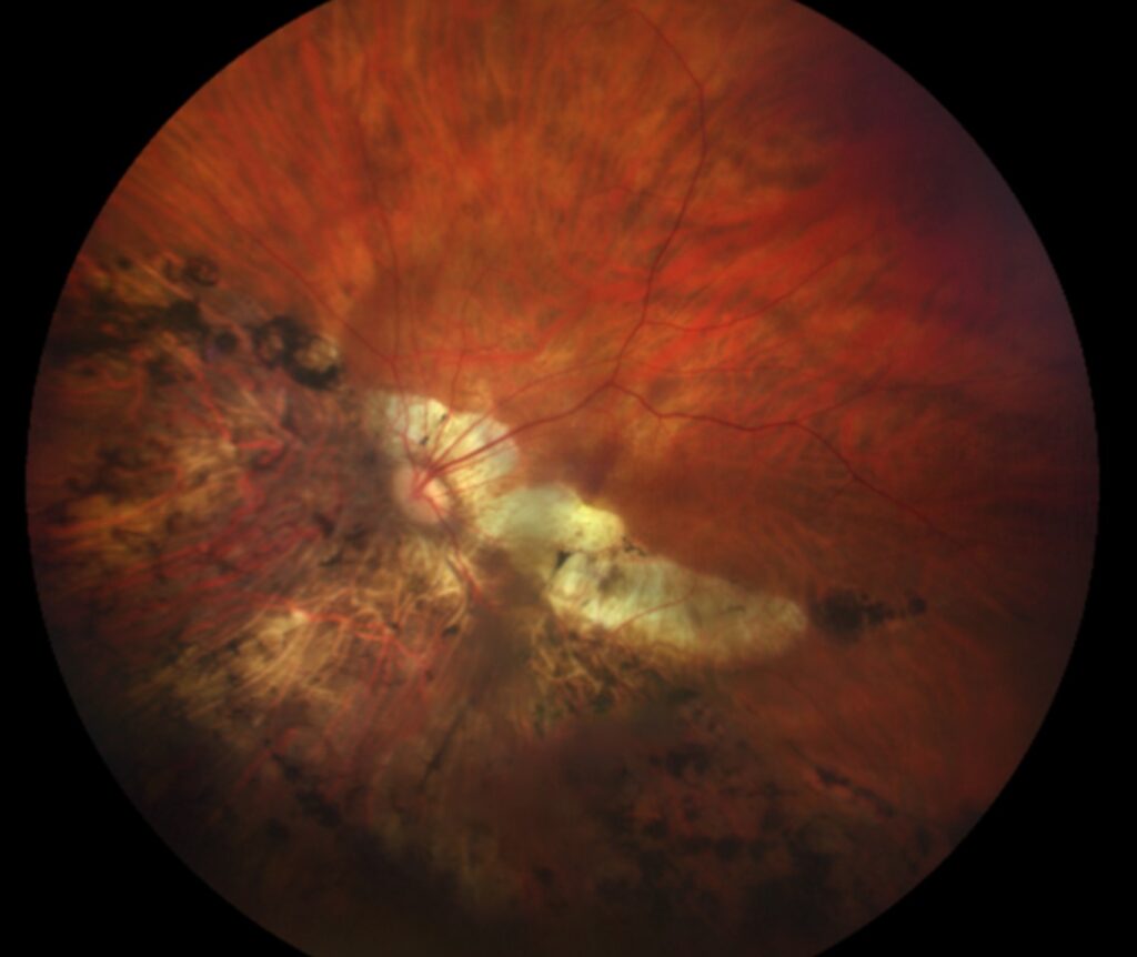 Clinical image illustrating Myopia Control in Children