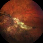 Clinical image illustrating Myopia Control in Children