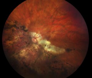 Clinical image illustrating Myopia Control in Children