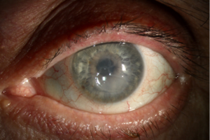 Clinical eye photograph illustrating Natamycin Voriconazole Keratitis