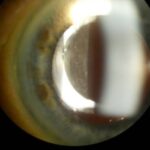 Clinical eye photograph illustrating Negative Dysphotopsia Iol Management