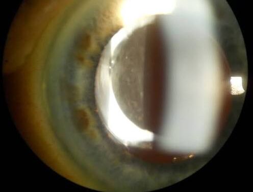 Negative Dysphotopsia: When a Perfect Cataract Surgery Still Leaves a Shadow