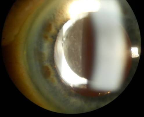 Clinical eye photograph illustrating Negative Dysphotopsia Iol Management