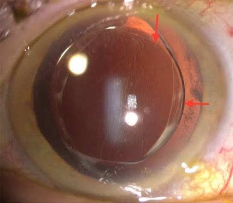 Clinical eye photograph illustrating Negative Dysphotopsia Iol Management