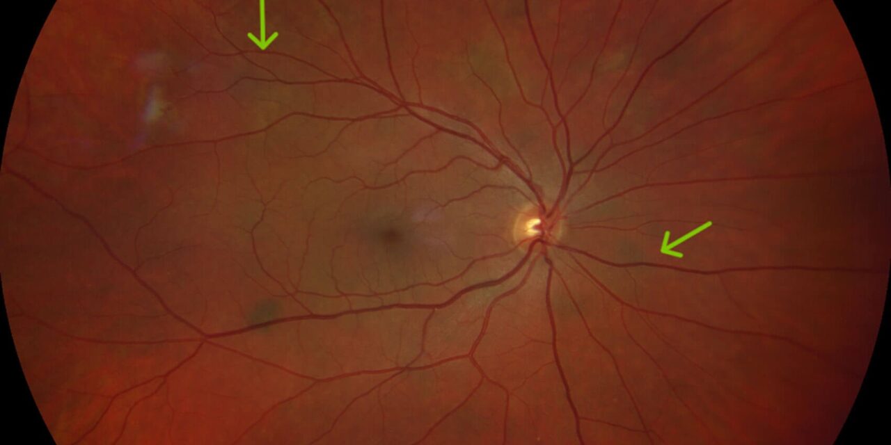 Ocular Findings in Neurofibromatosis Type 2: A Different Eye Disease From Type 1