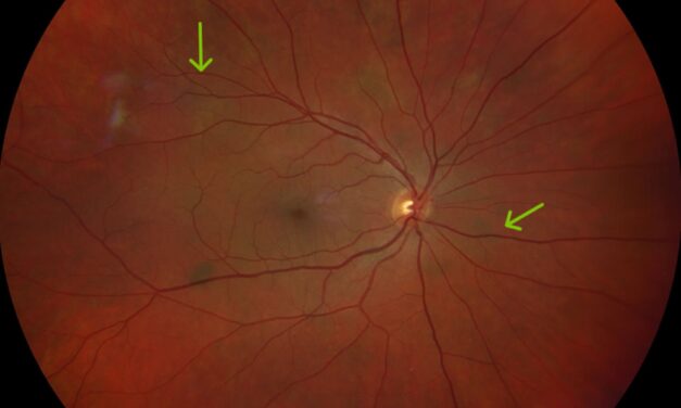 Ocular Findings in Neurofibromatosis Type 2: A Different Eye Disease From Type 1