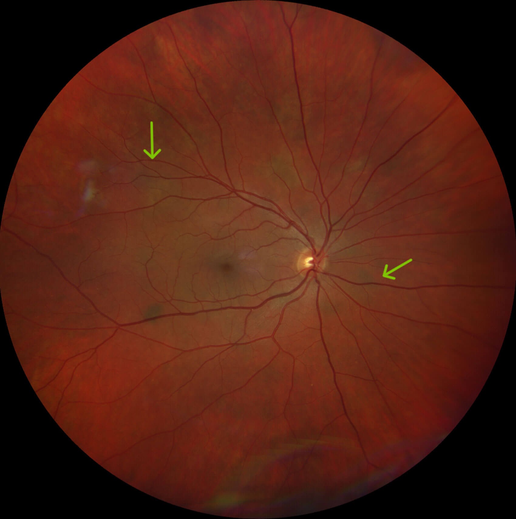 Clinical eye photograph illustrating Neurofibromatosis 2 Ocular Findings