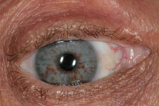 Clinical eye photograph illustrating Neurofibromatosis 2 Ocular Findings