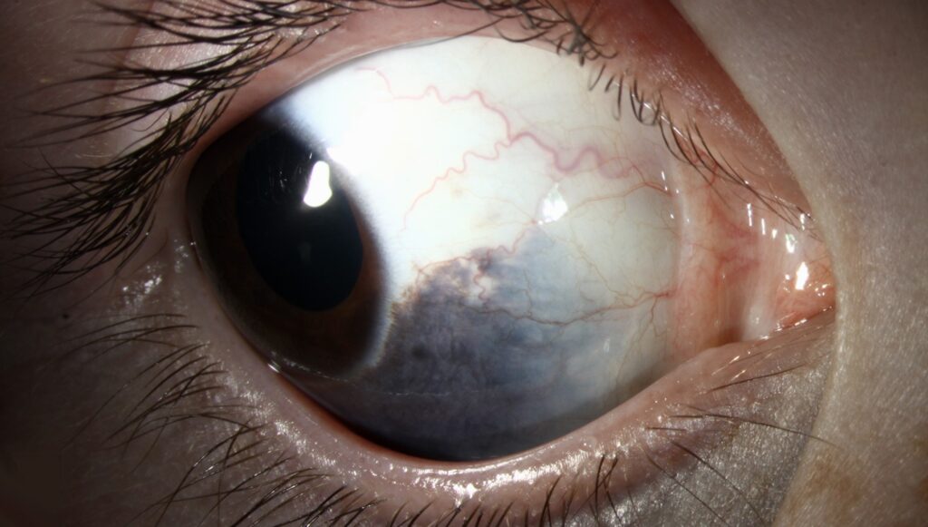 Clinical eye photograph illustrating Nevus of Ota Oculodermal Melanocytosis