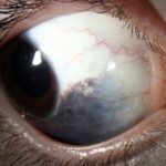 Clinical eye photograph illustrating Nevus of Ota Oculodermal Melanocytosis