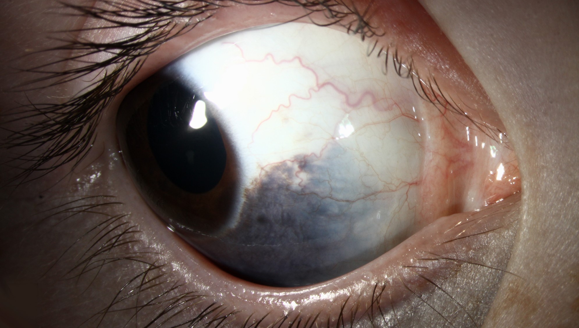 Clinical eye photograph illustrating Nevus of Ota Oculodermal Melanocytosis