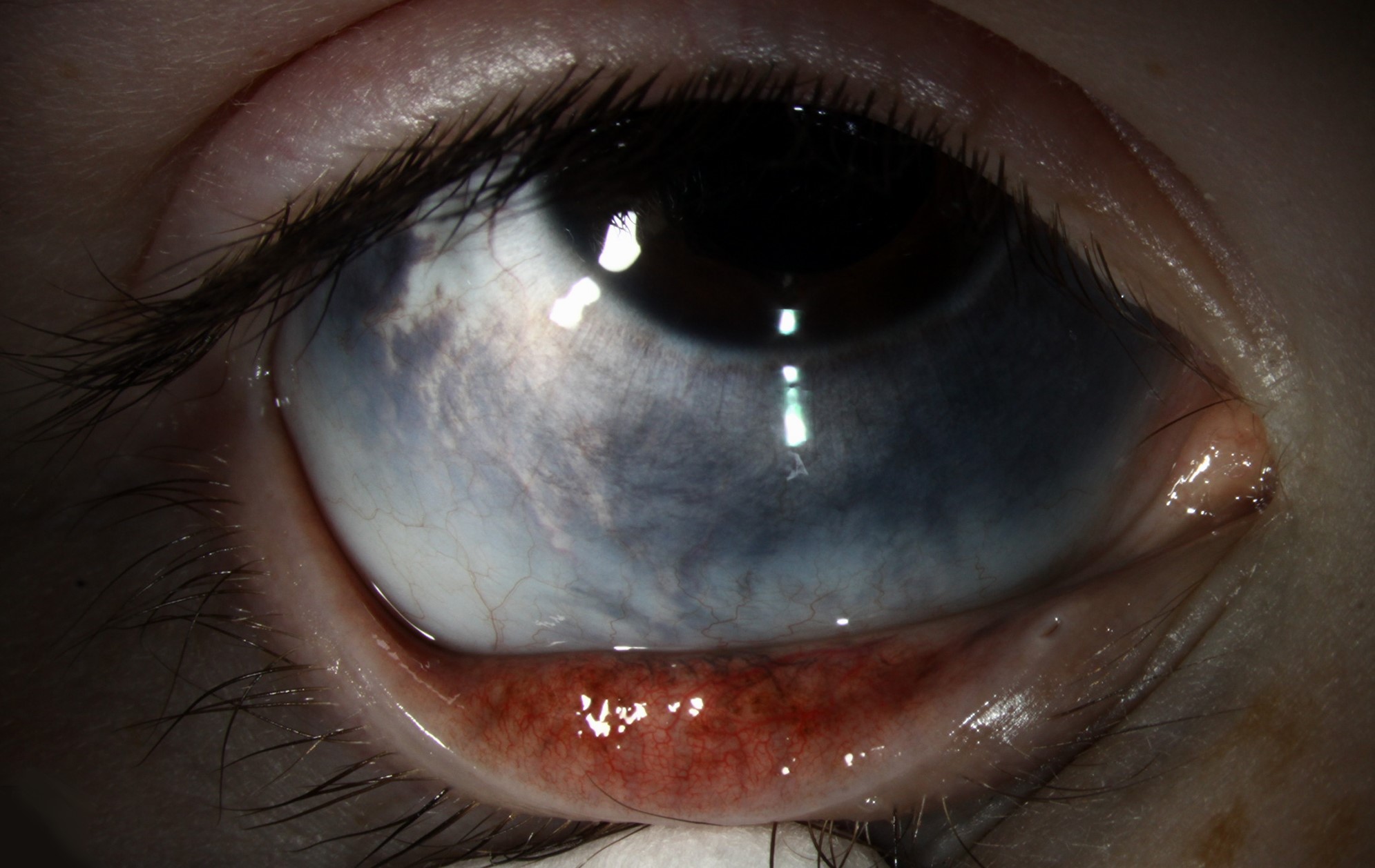 Clinical eye photograph illustrating Nevus of Ota Oculodermal Melanocytosis
