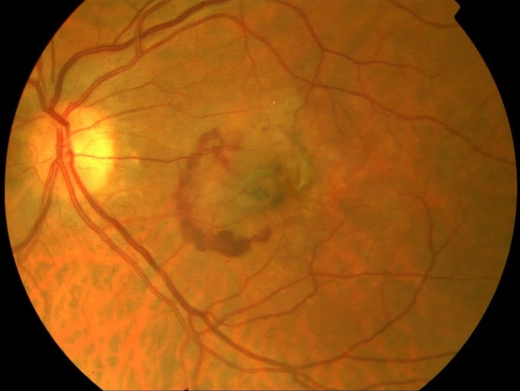New Treatments for Neovascular AMD: What Is Changing