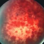 Clinical eye photograph illustrating Newborn Retinal Hemorrhage