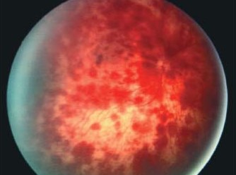 Retinal Hemorrhages in the Newborn: How Common They Are and How to Tell Them From Abuse