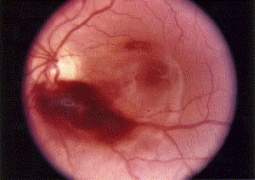 Clinical eye photograph illustrating Newborn Retinal Hemorrhage