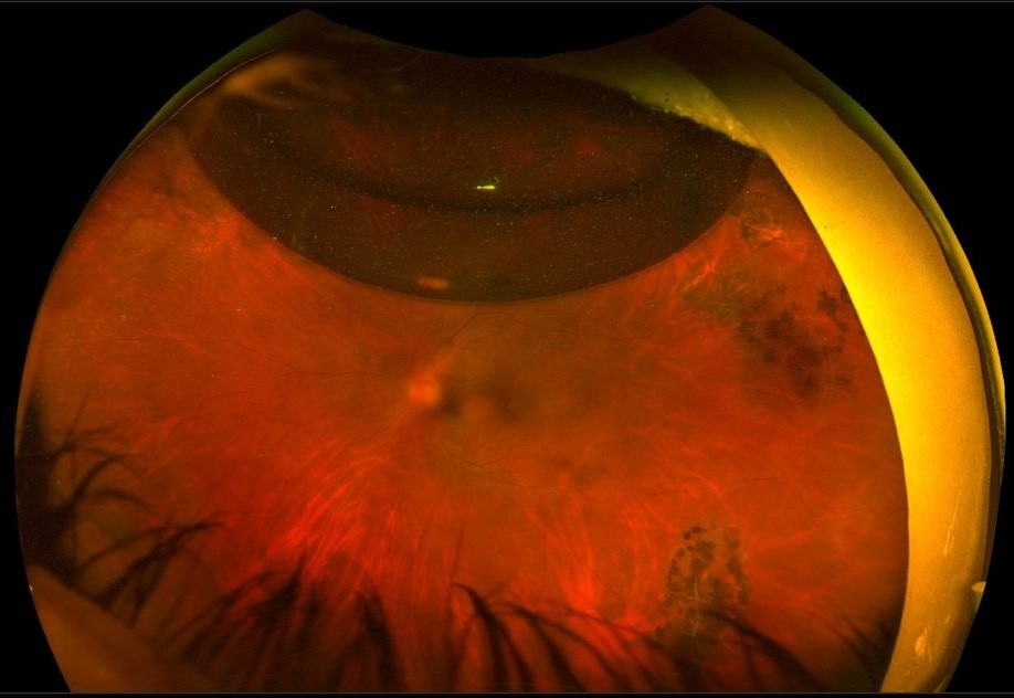 Clinical image illustrating Nitrous Oxide and Intraocular Gas