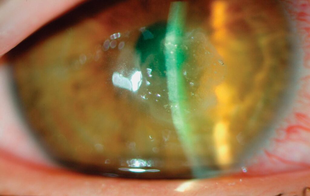 Clinical eye photograph illustrating Nocardia Keratitis