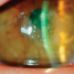 Clinical eye photograph illustrating Nocardia Keratitis