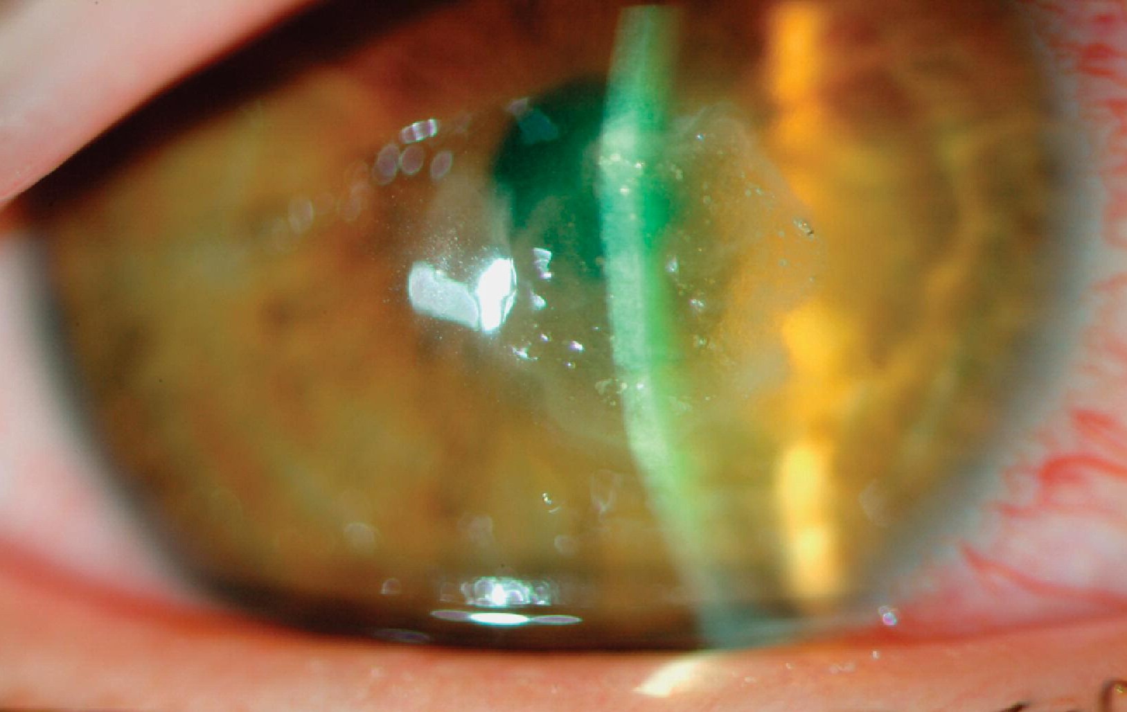 Clinical eye photograph illustrating Nocardia Keratitis