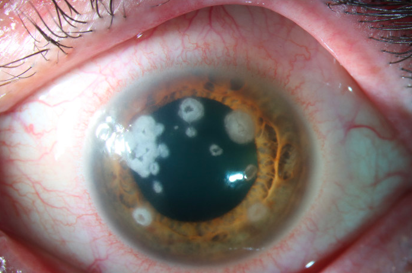 Clinical eye photograph illustrating Nocardia Keratitis