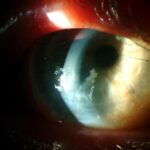 Clinical eye photograph illustrating Nontuberculous Mycobacterial Keratitis